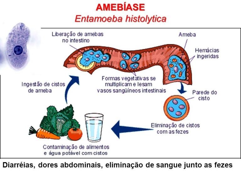 Amebíase: o que é, sintomas, causas, diagnóstico e tratamento